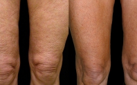 thermage_cuisse_v2.jpg