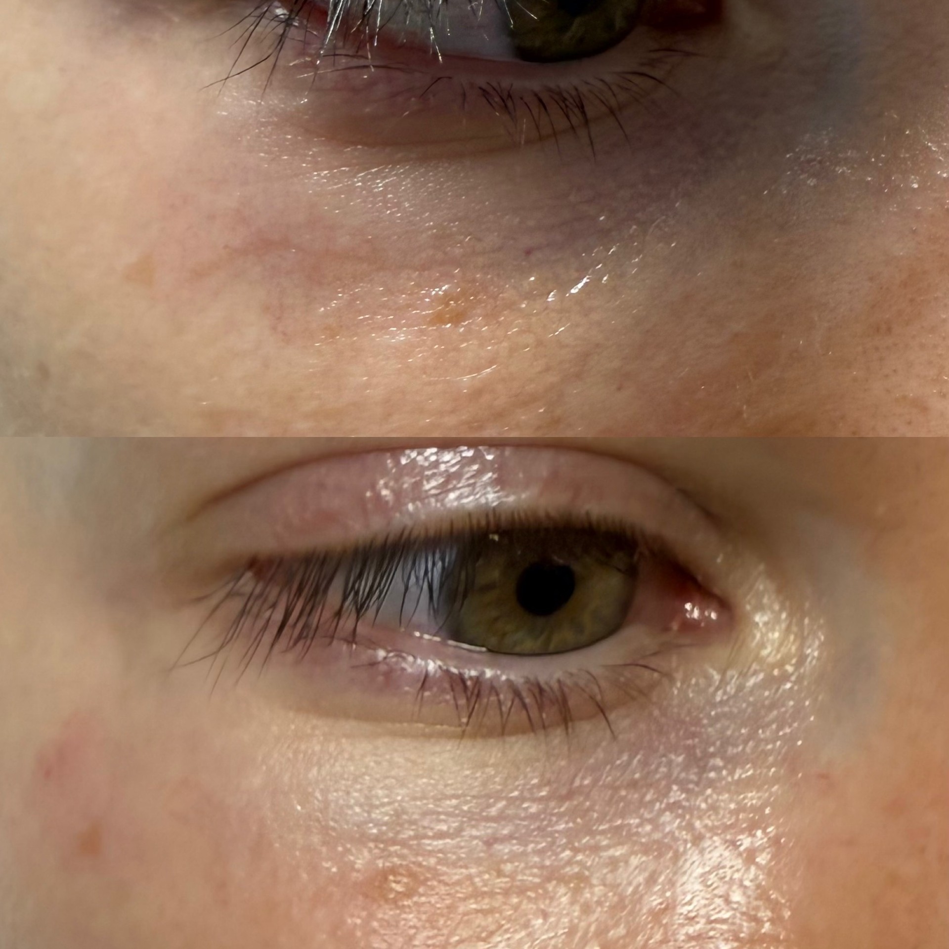 detatouage-laser-nantes.JPG