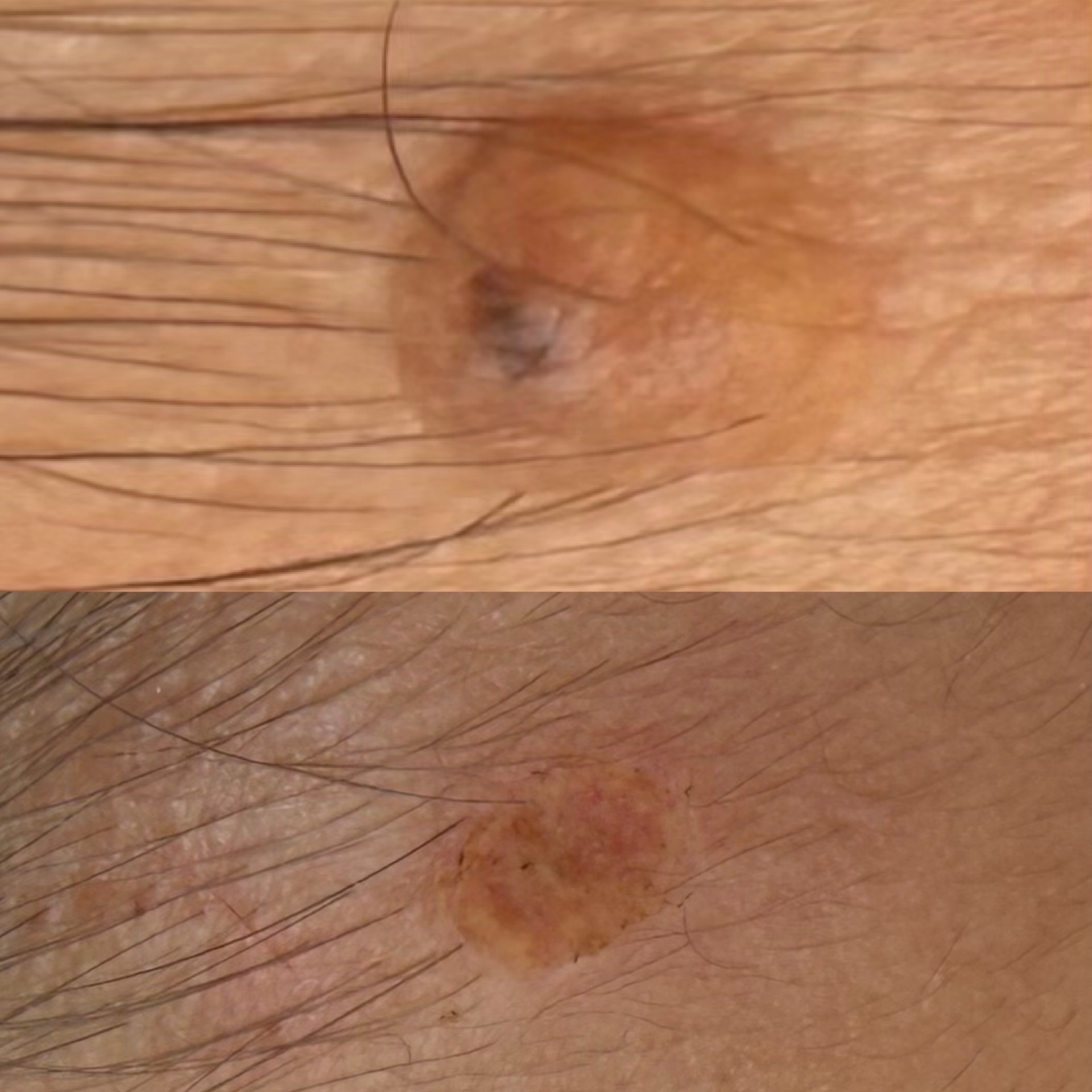 detatouage-laser-nantes.JPG