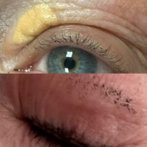 paupières xanthelasma plexr