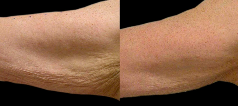 detatouage-laser-nantes.JPG