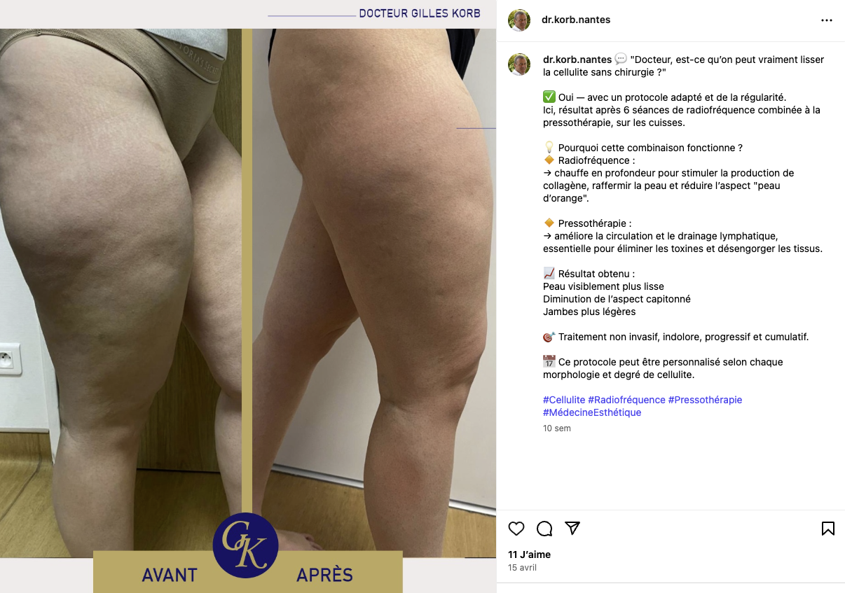 traitement cellulite cuisses avant après