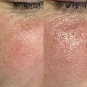 couperose joues laser
